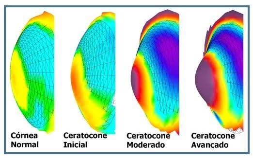 Progressão do ceratocone demonstrada por análise tridimensional da córnea.